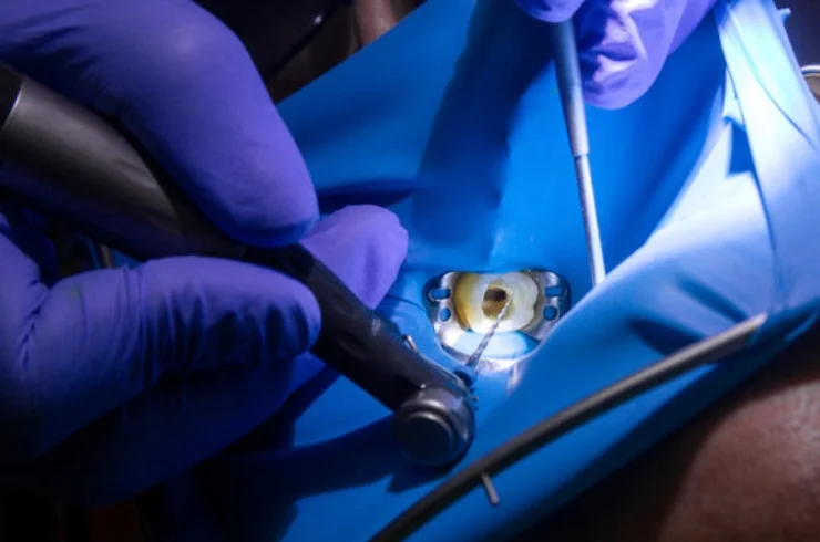 Endodontics (Root Canal Specialties)-------0