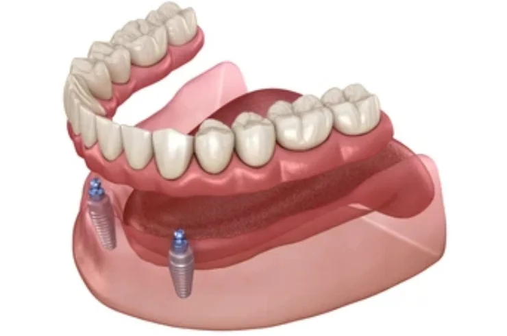 Implant-supported overdentures-------0