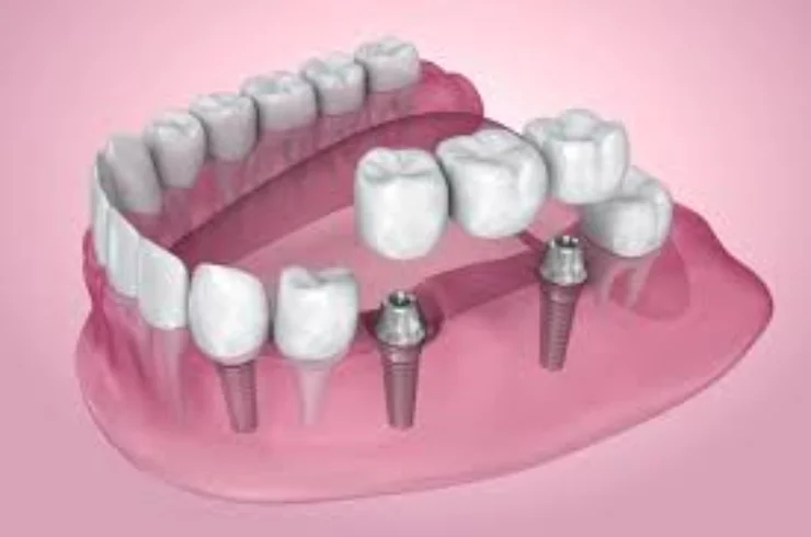 Single and multiple dental implants------0